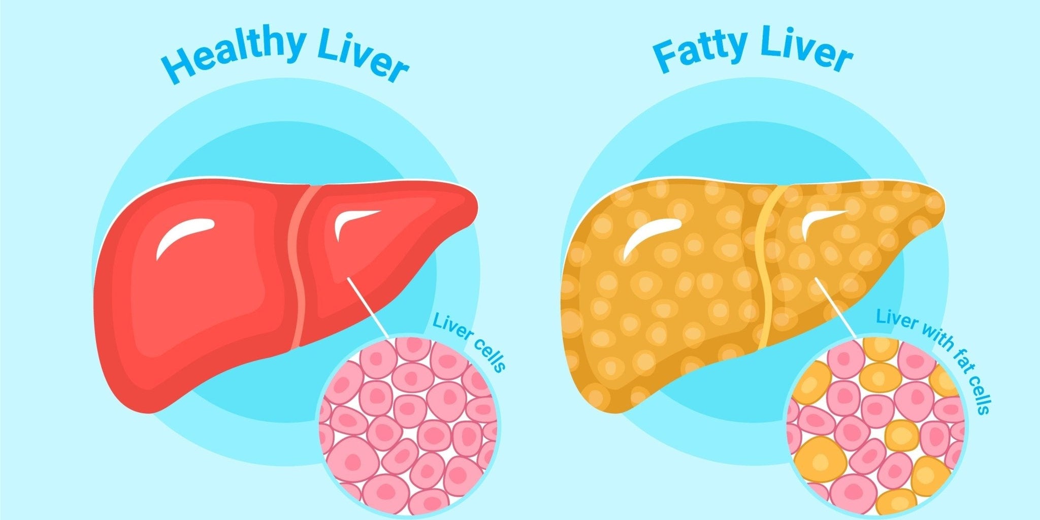 Best Liver Supplements for Fatty Liver: Why Milk Thistle is The Ultimate Liver Detox? - IMMUNOSCIENCES