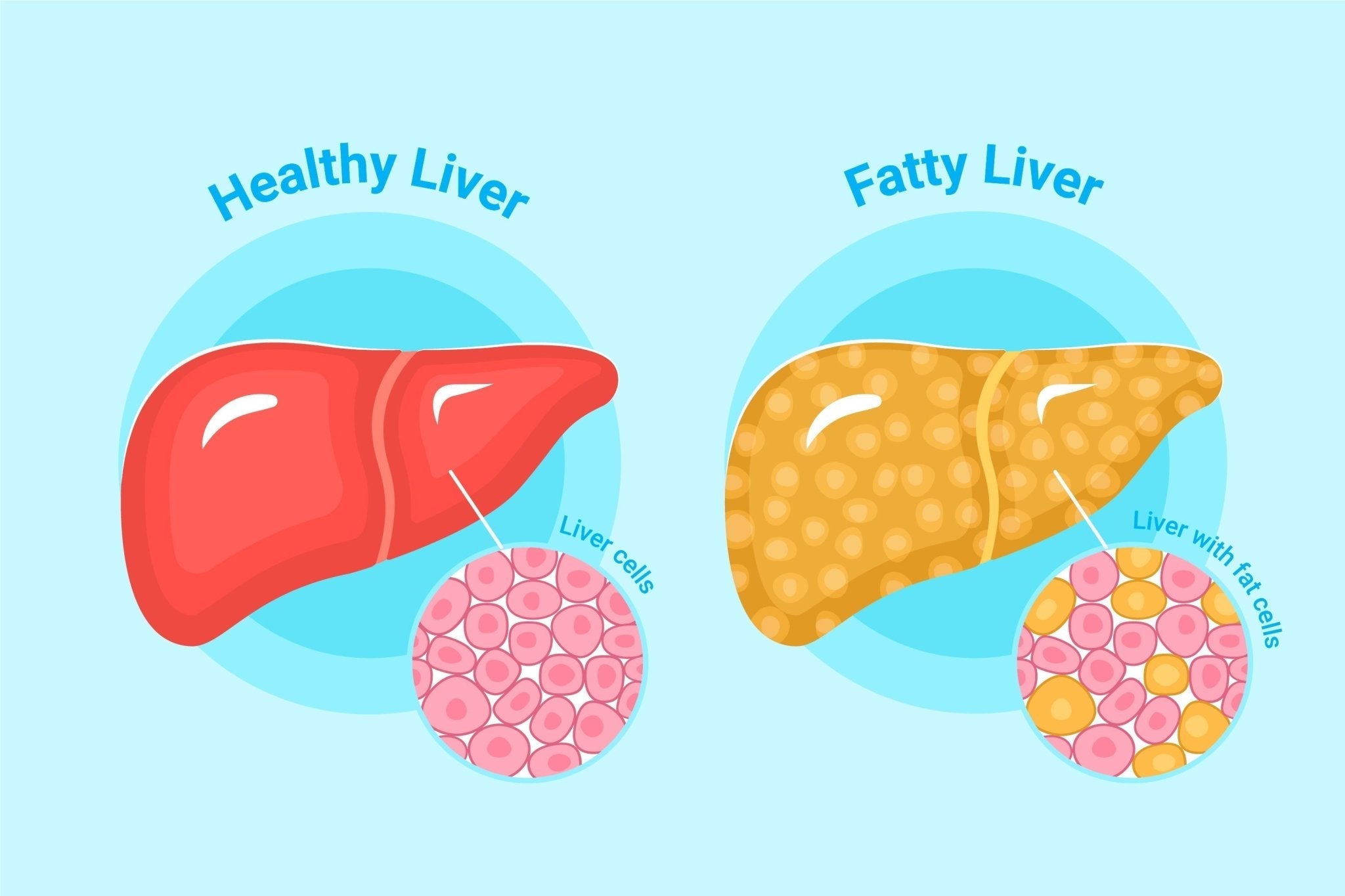Best Liver Supplements for Fatty Liver: Why Milk Thistle is The Ultimate Liver Detox? - IMMUNOSCIENCES