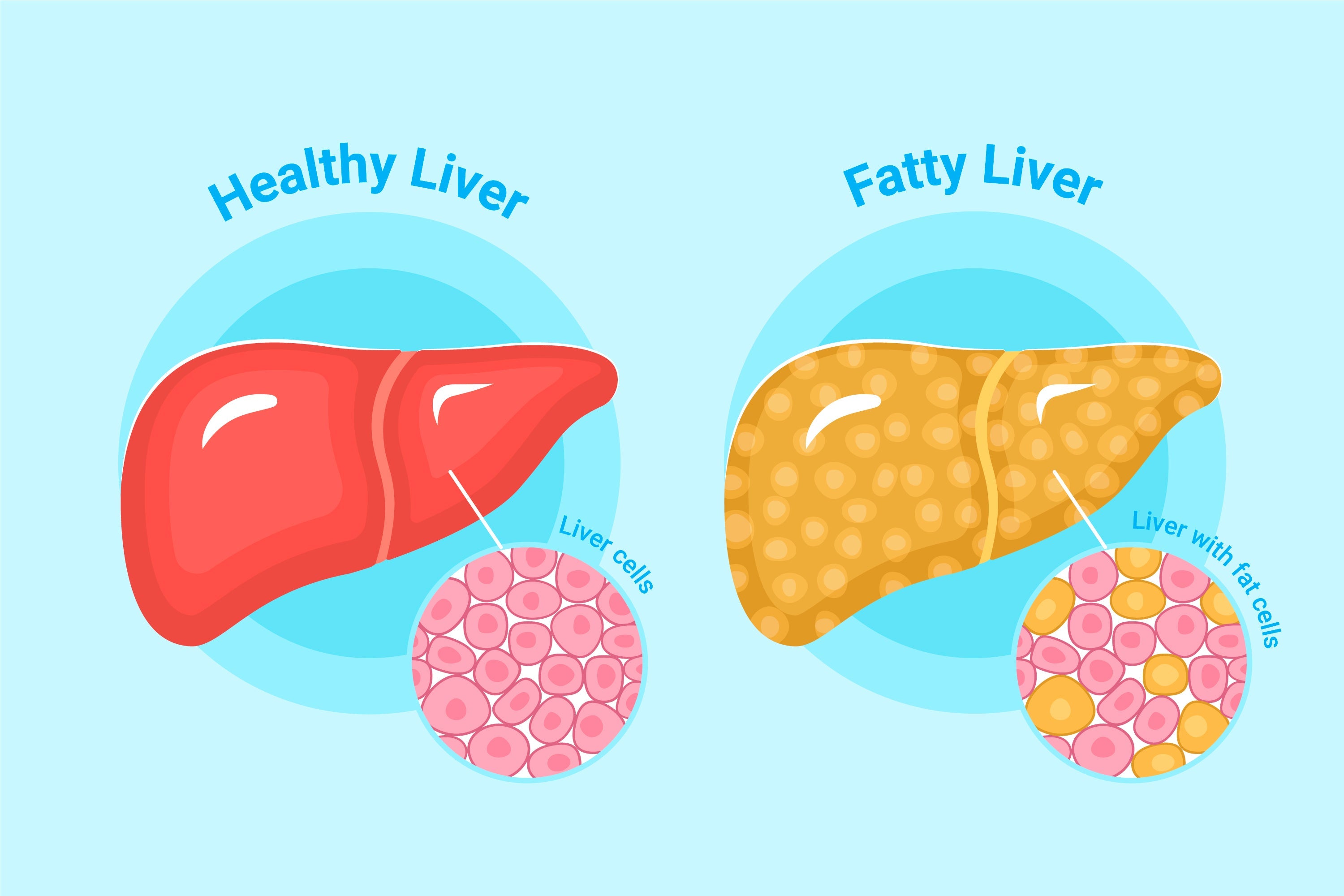 Best Liver Supplements for Fatty Liver