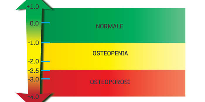 What is T Score in Bone Density Tests and Why It Matters for Your Health? - IMMUNOSCIENCES