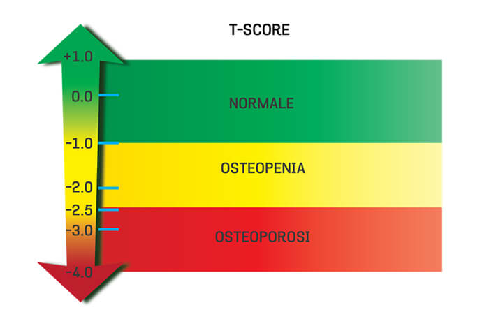 What is A T Score in Bone Density Tests